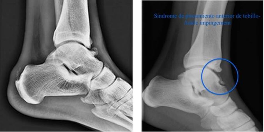 sindrome pinzamiento anterior tobillo lucas llamas